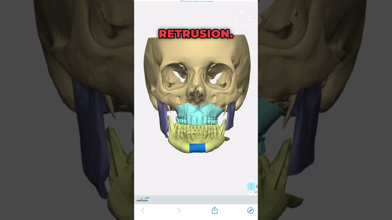 Transform Your Smile: Correct Asymmetry with Orthognathic Surgery 🦷