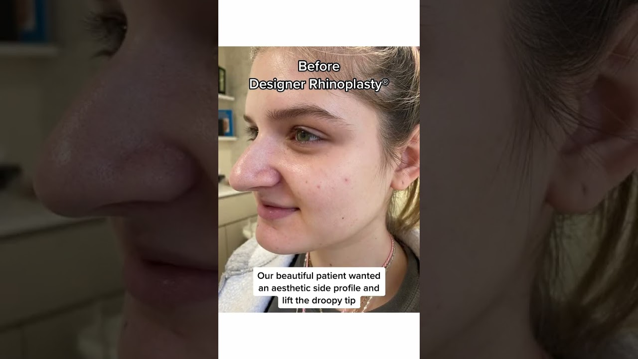6 Months Post-Designer Rhinoplasty Results ✨