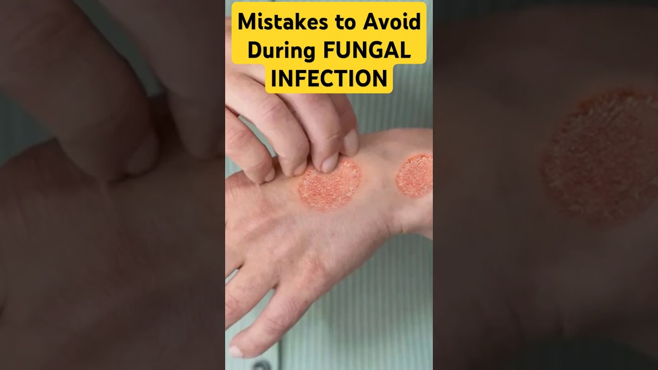 बार-बार फंगल संक्रमण क्यों हो रहे हैं? जानिए विशेषज्ञ की सलाह 🩺