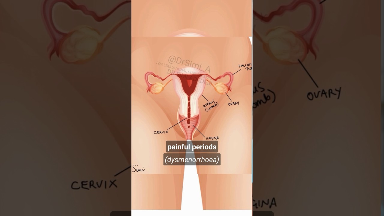 2 Types of Painful Periods: Primary & Secondary Dysmenorrhea 🩸