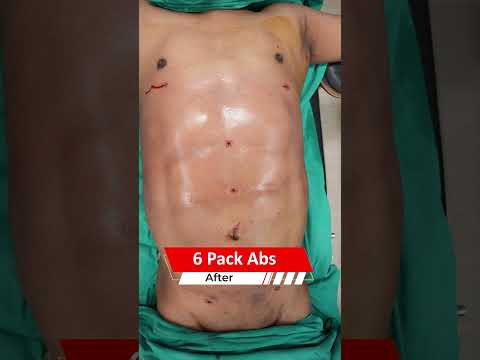 6 Pack Abs surgery | Six Pack Abs surgery Result | Liposuction cost #shortvideo #shots