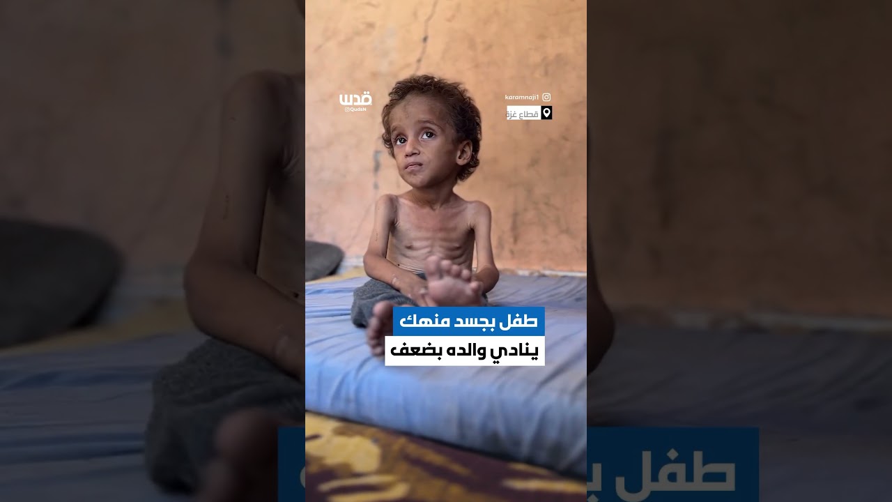 المجاعة تفتك بأجساد أطفال غزة