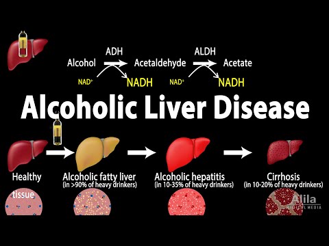 Alcoholic Liver Disease, Animation