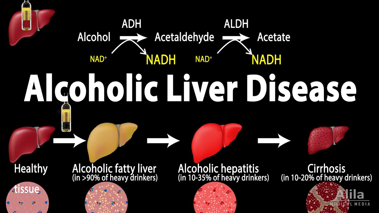 Alcoholic Liver Disease Explained: Symptoms, Risk Factors & Diagnosis 🩺