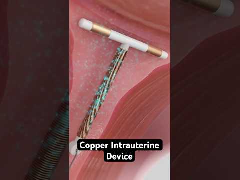 Copper IUD Birth Control (3D Animation)