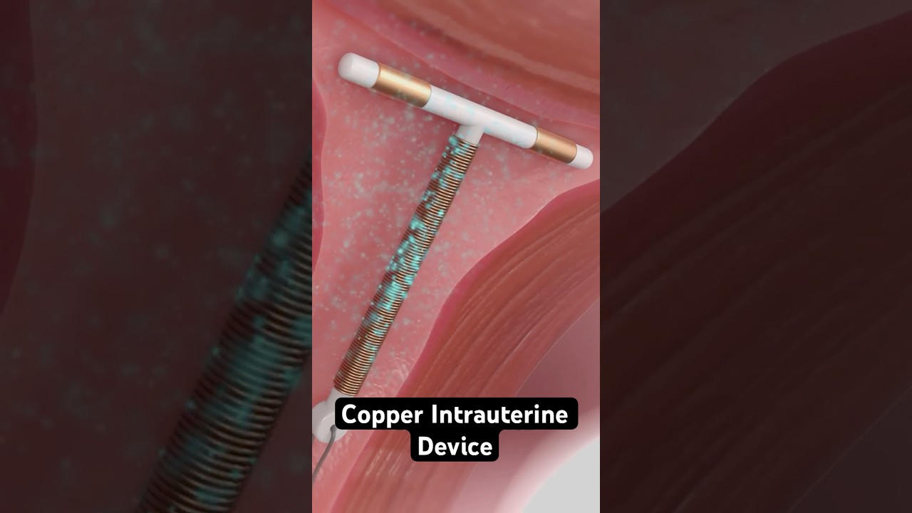 How Copper IUD Birth Control Works: 3D Animation Explained 🛡️