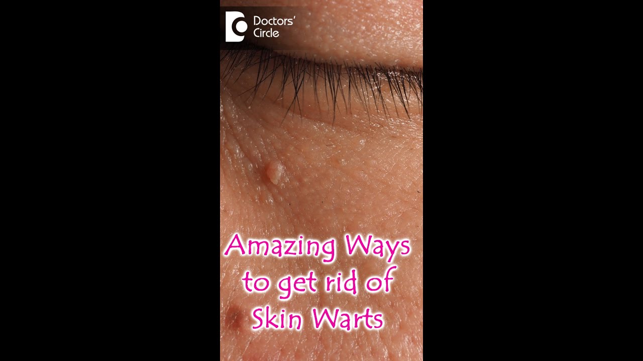 Effective Tips to Remove Skin Warts 🩺
