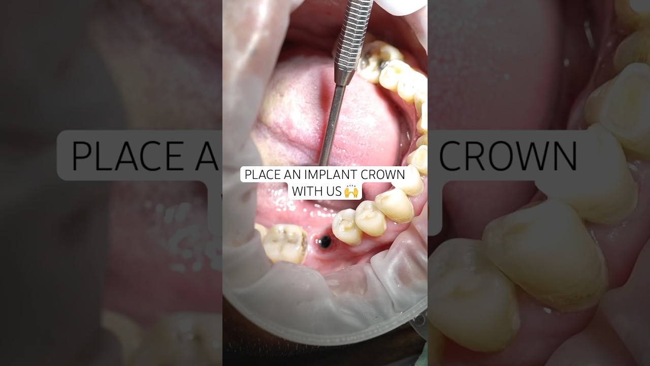 Placing an Implant Crown: Step-by-Step ๐