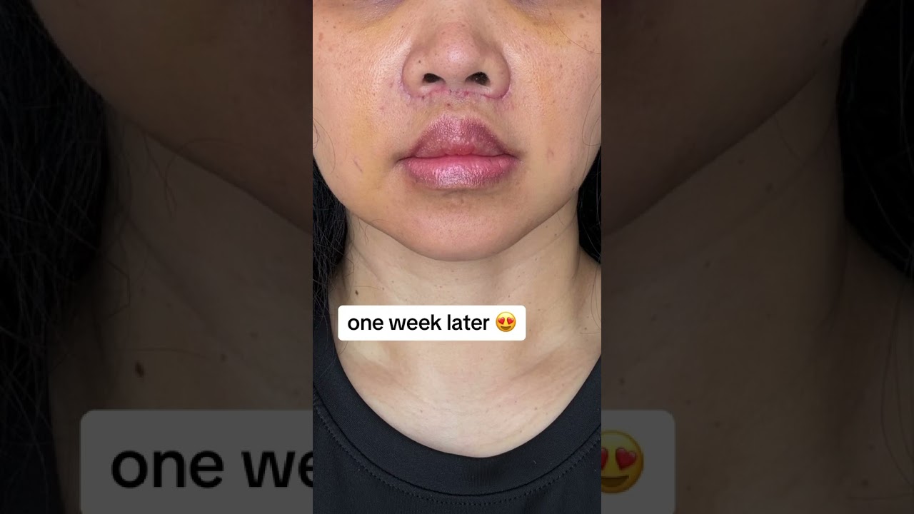 Lip Lift Surgery Results #plasticsurgery #plasticsurgeon #beforeandafter