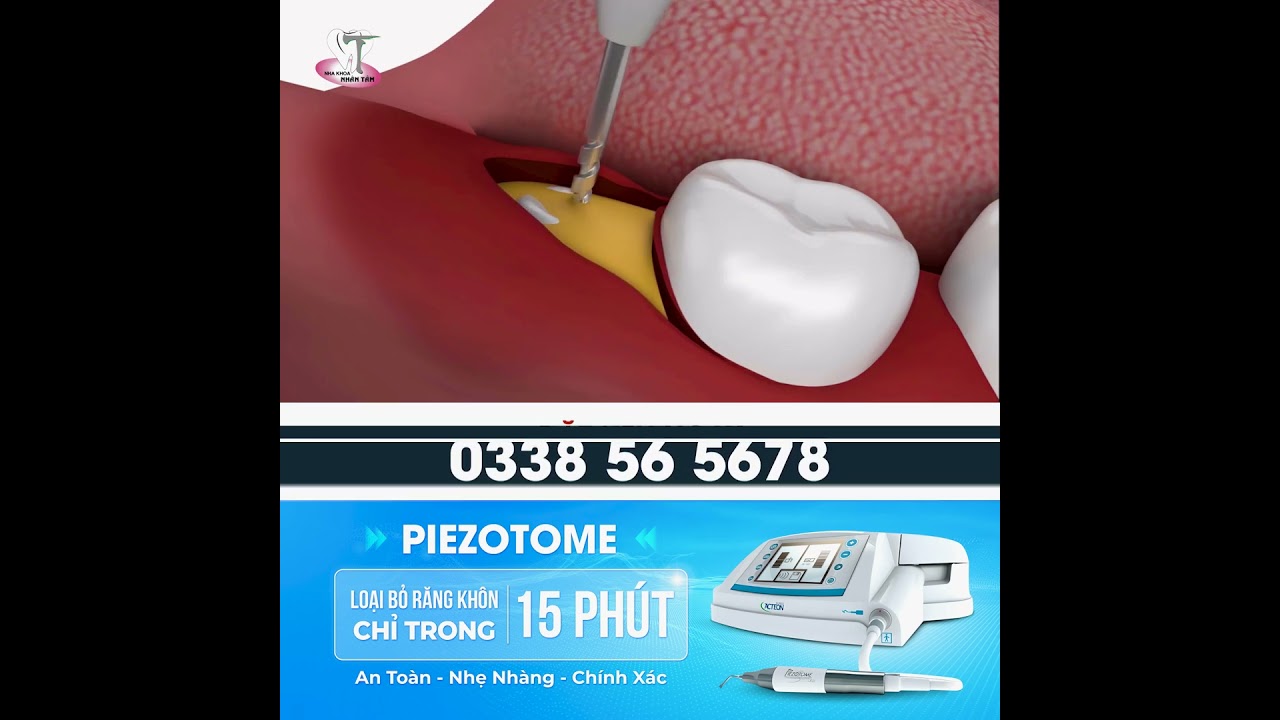 Nhổ Răng Khôn An Toàn Với Máy Siêu Âm Piezotome