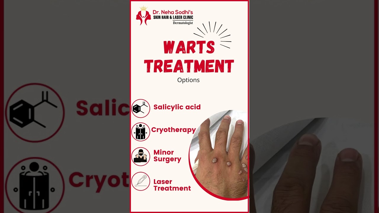 Effective Warts Treatment Options
