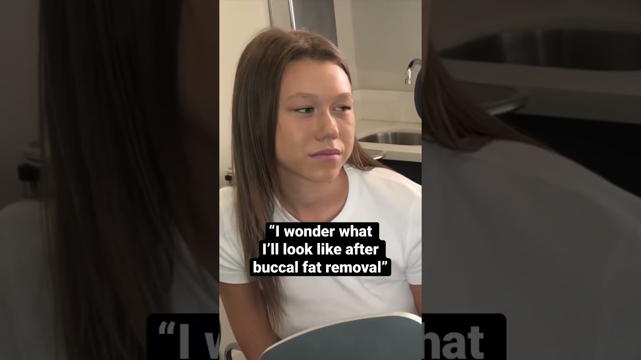 Stunning Buccal Fat Removal Transformations: Before & After ✨
