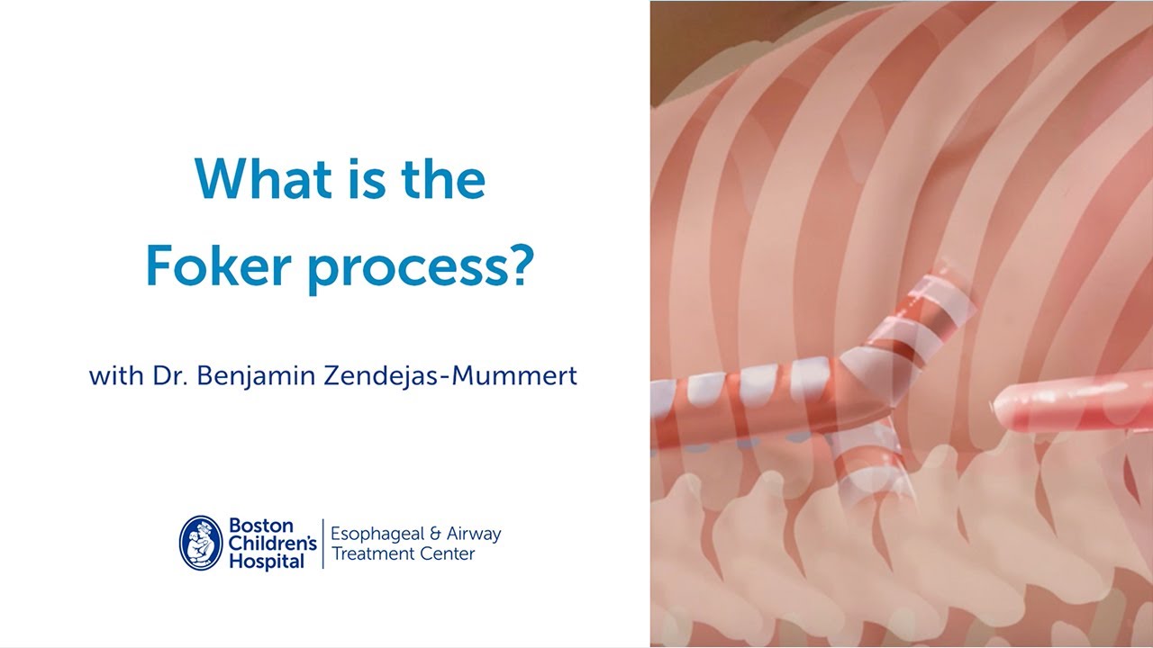 Foker Process: Innovative Surgery for Esophageal Atresia