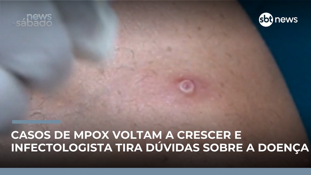 Brasil registra novos casos de Mpox em 2026 🚨
