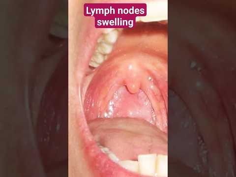 Lymph node swelling рдХреЗ рдХрд╛рд░рдг
