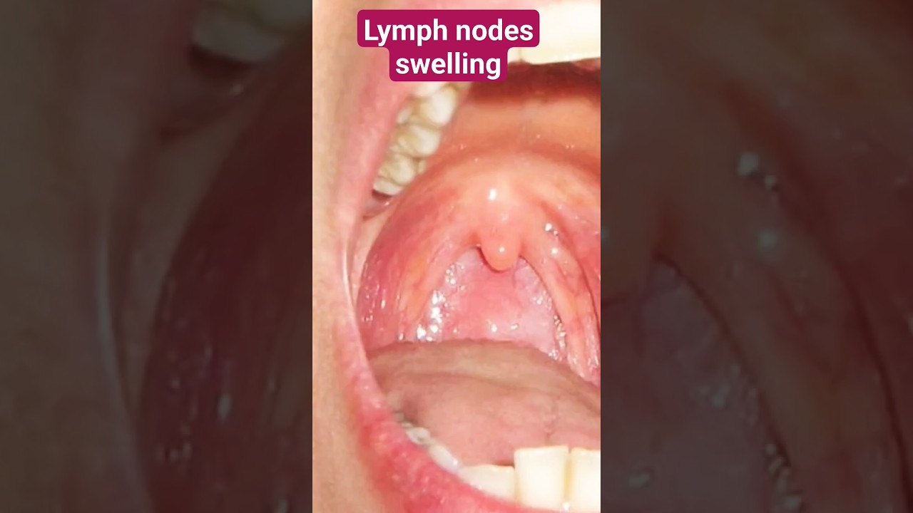 Lymph Node Swelling: Causes & Expert Advice 💬