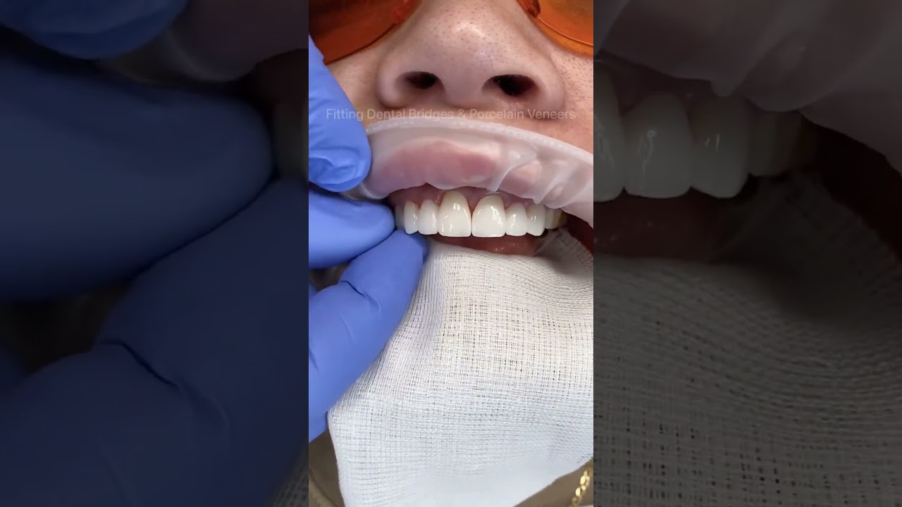 Porcelain Bridges & Veneers for a Fuller Smile 😊