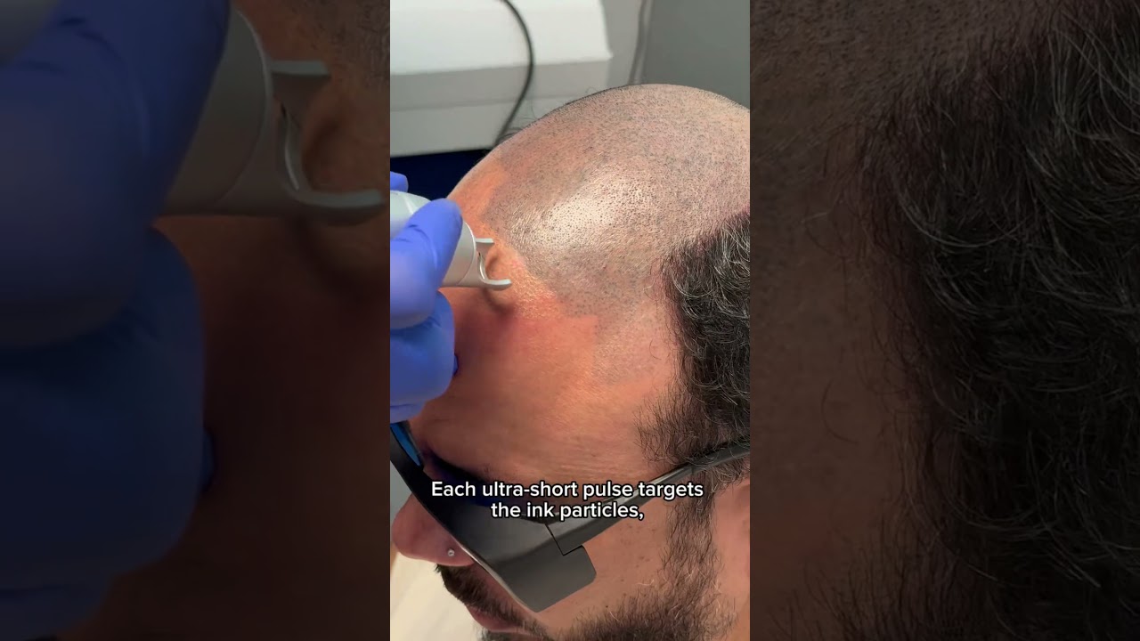 Scalp Micropigmentation Removal with Pico Laser ✨