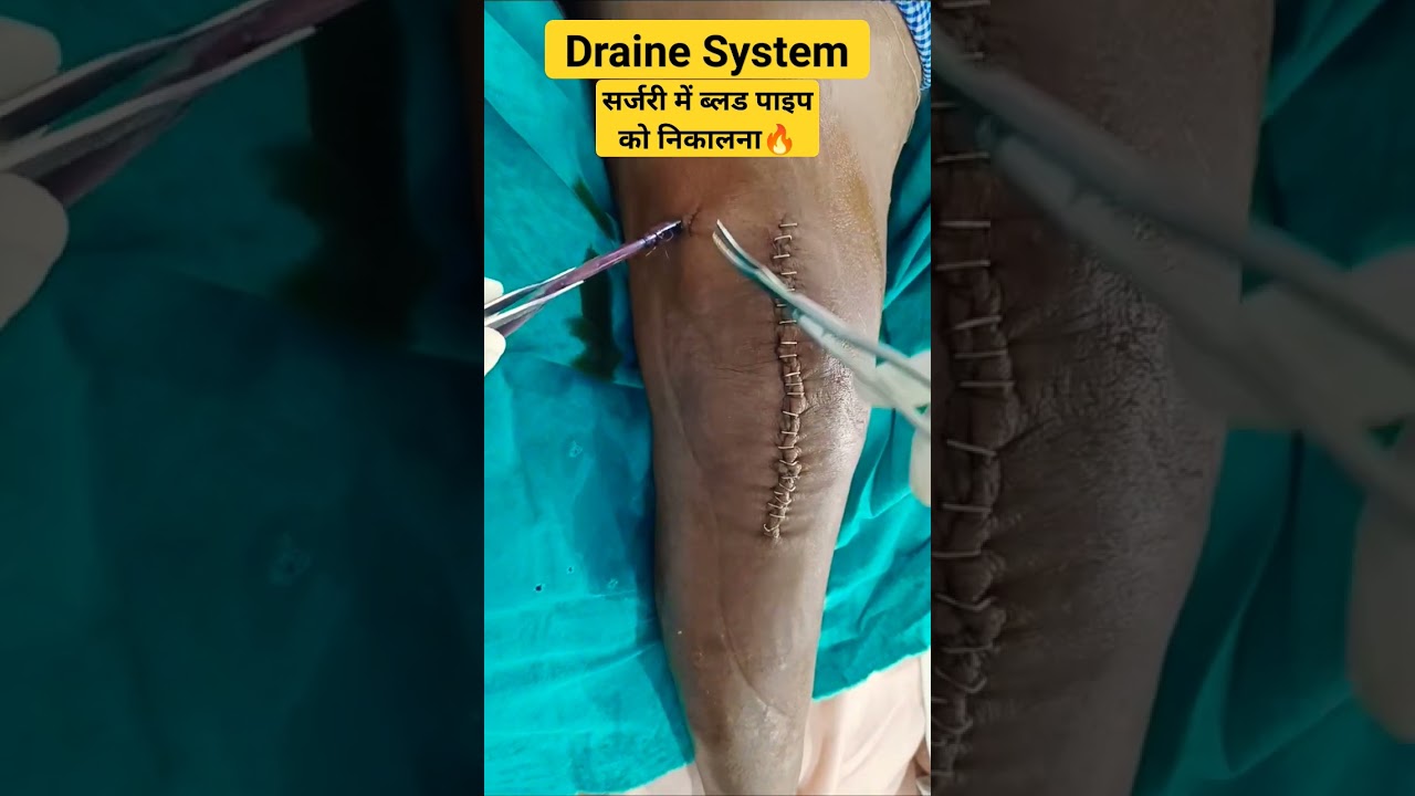 Blood Drain System After Surgery: How It Works to Remove Clotted Blood🔥