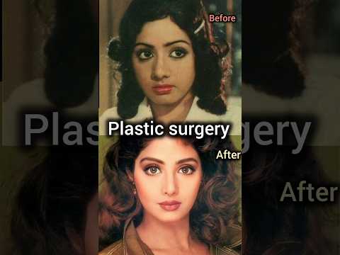 Shridevi has done 29 plastic surgeries to look beautiful#shorts #shridevi  #plasticsurgery