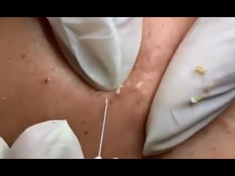 Ateroma Cyst Removal HD Video 🧴