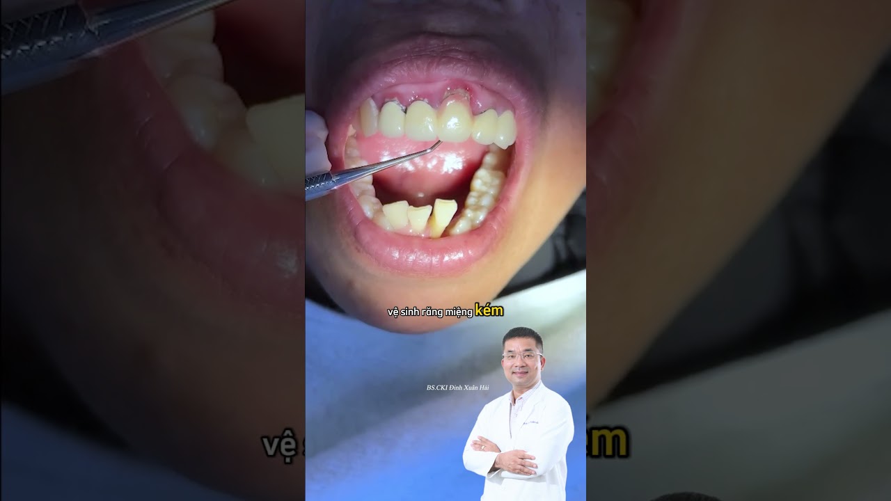 Vì sao răng đẹp nhưng bị viêm nướu? 🤔