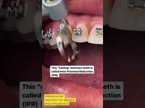 What is Interproximal reduction ? Why and how ? #IPR #orthdontics #aligners