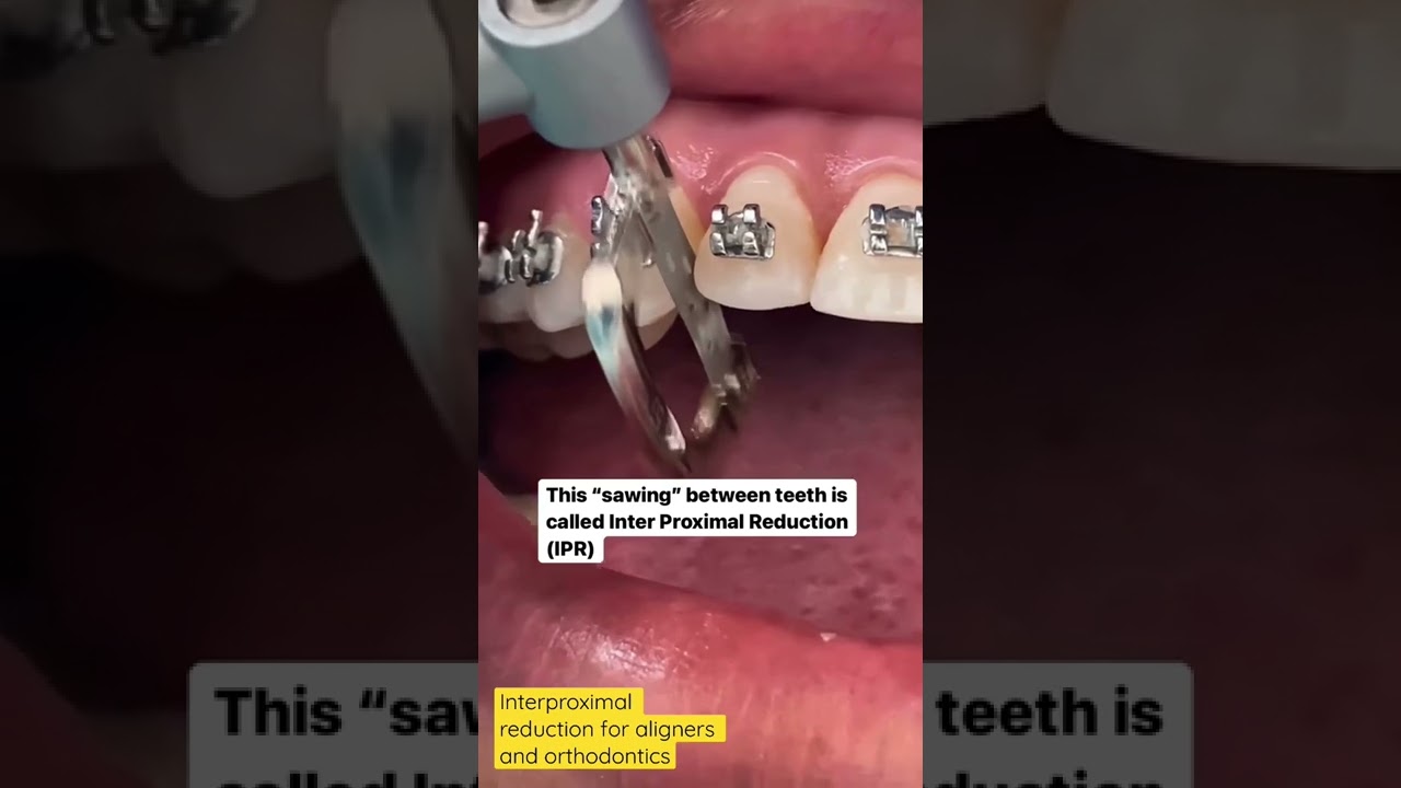 Interproximal Reduction (IPR) Explained: Why & How It’s Done in Orthodontics 🦷