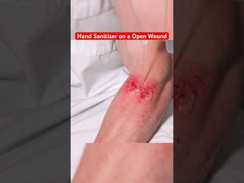Putting Hand Sanitizer on a Open Wound... #funny #science #comedy