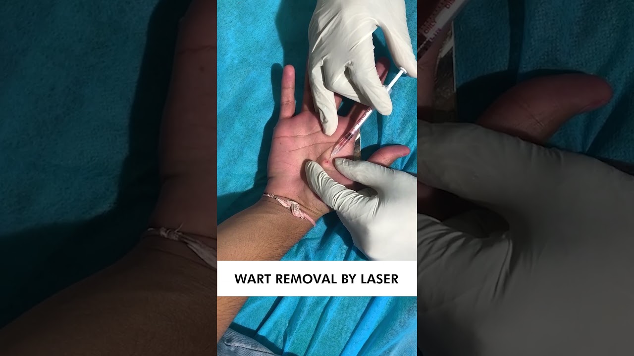Laser Wart Removal at Skinaa Clinic ✨