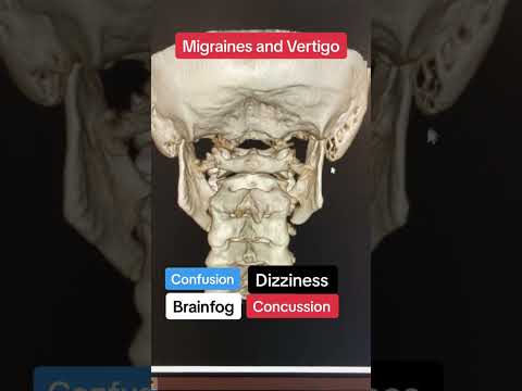 3D Atlas Misalignment #migraines #vertigo #dizziness #brainfog #confusion #xray  #uppercervicalcare