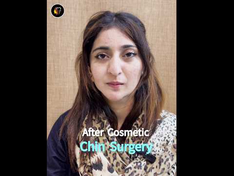 Genioplasty | Asymmetric Face Treatment | Dr Tauseef Ahmad