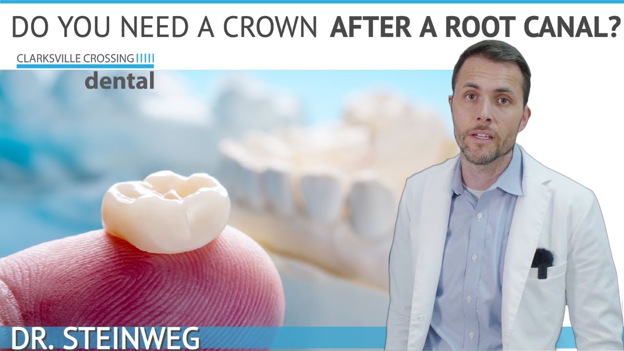 Dental Crown After Root Canal: Do You Need It? 🤔