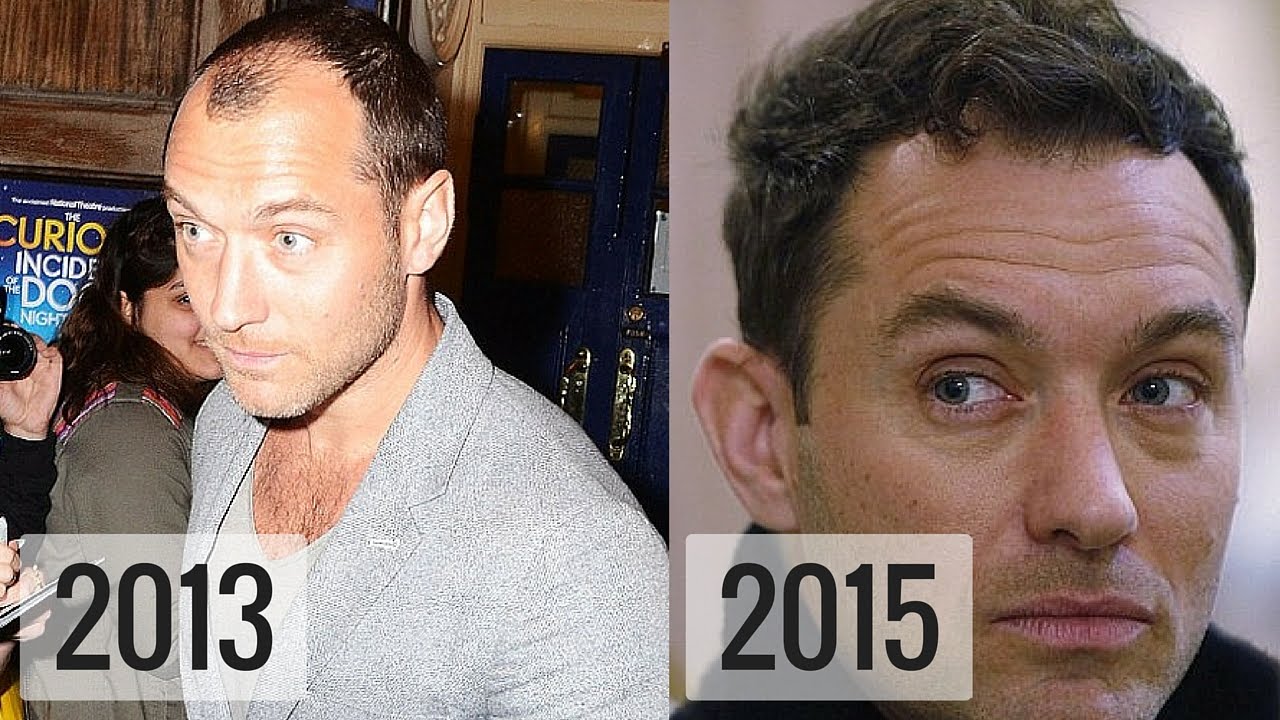 Did Jude Law Get a Hair Transplant? 🤔