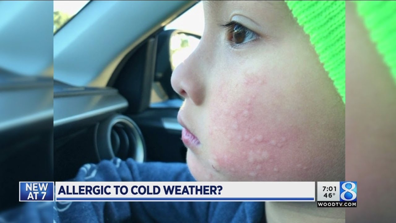 Doctor Explains Cold Weather Allergies ❄️