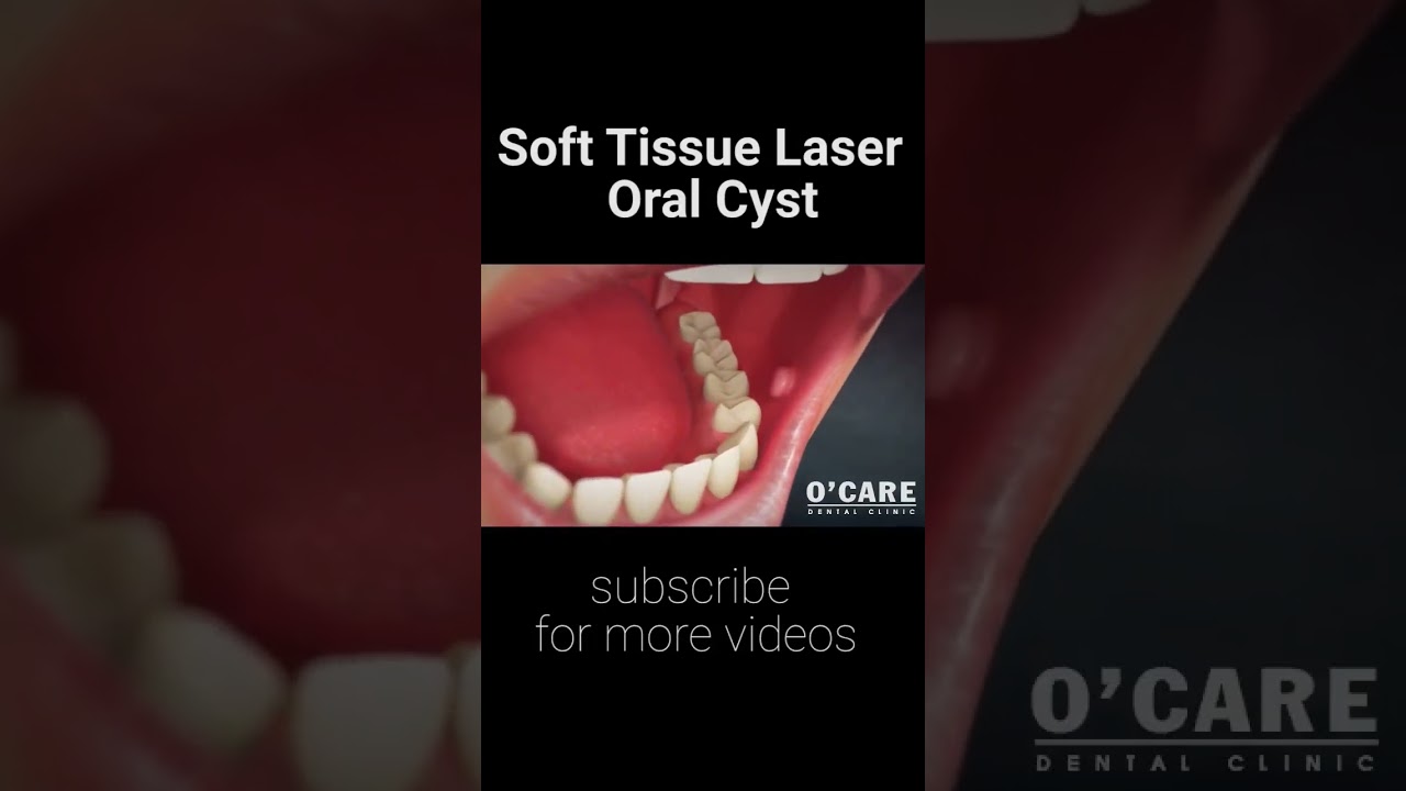 Cắt U Nang Nhầy Hiệu Quả tại Nha Khoa 🦷