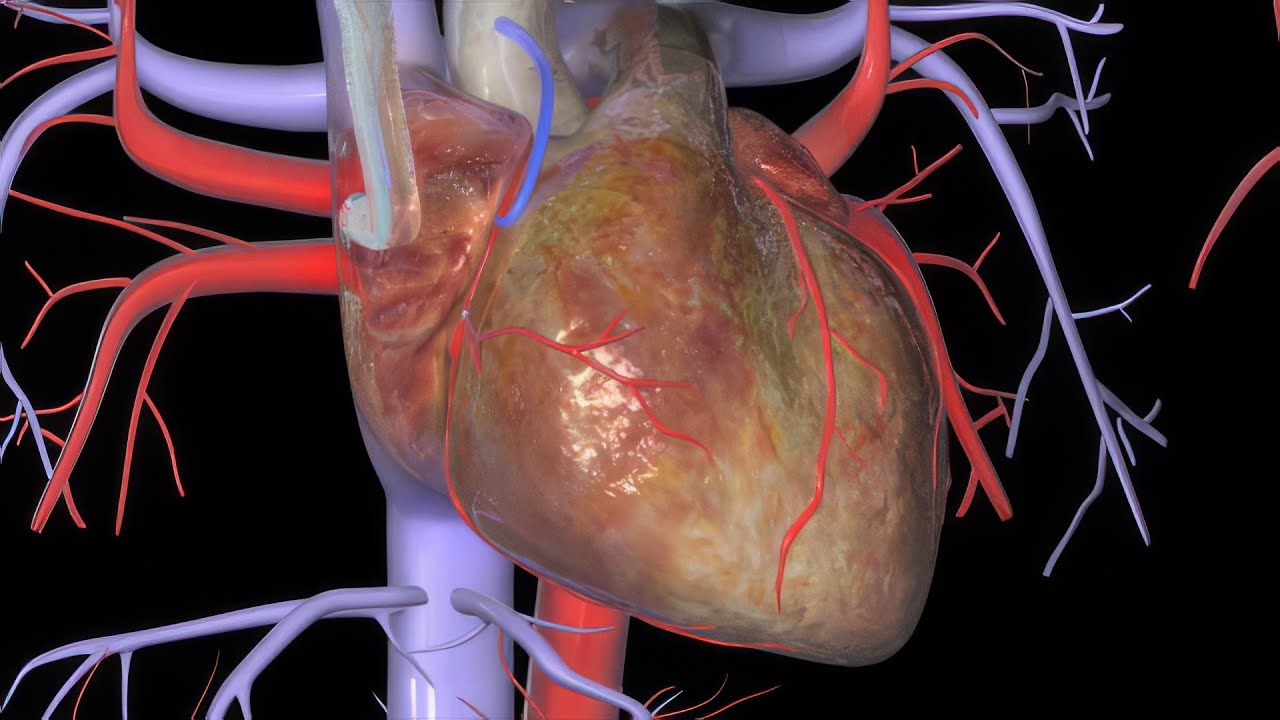 Heart Bypass Surgery (CABG) Explained 🫀