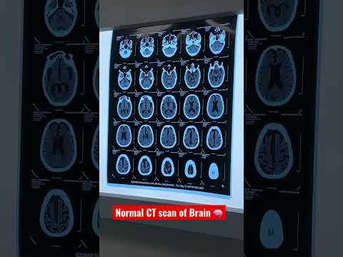 Normal CT scan of Brain 🧠