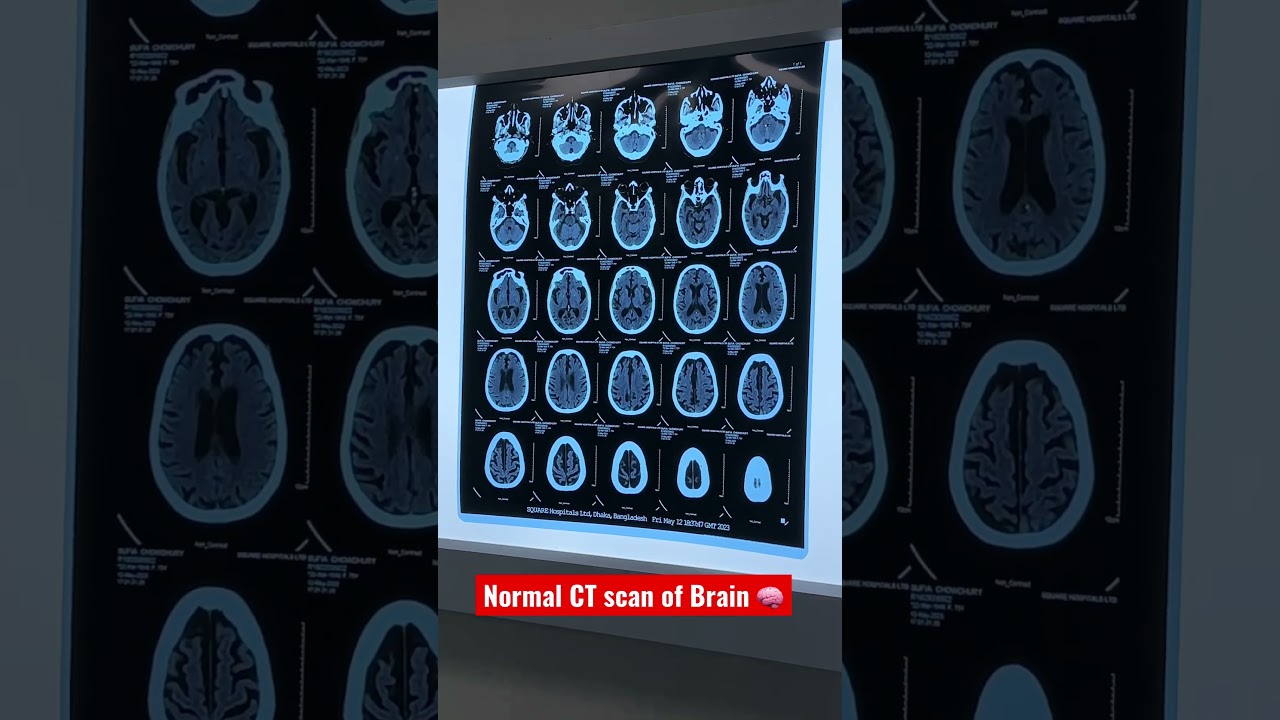 Normal Brain CT Scan