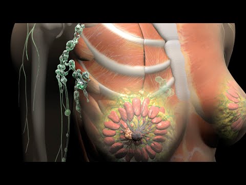 Breast Cancer Staging Overview ποΈ