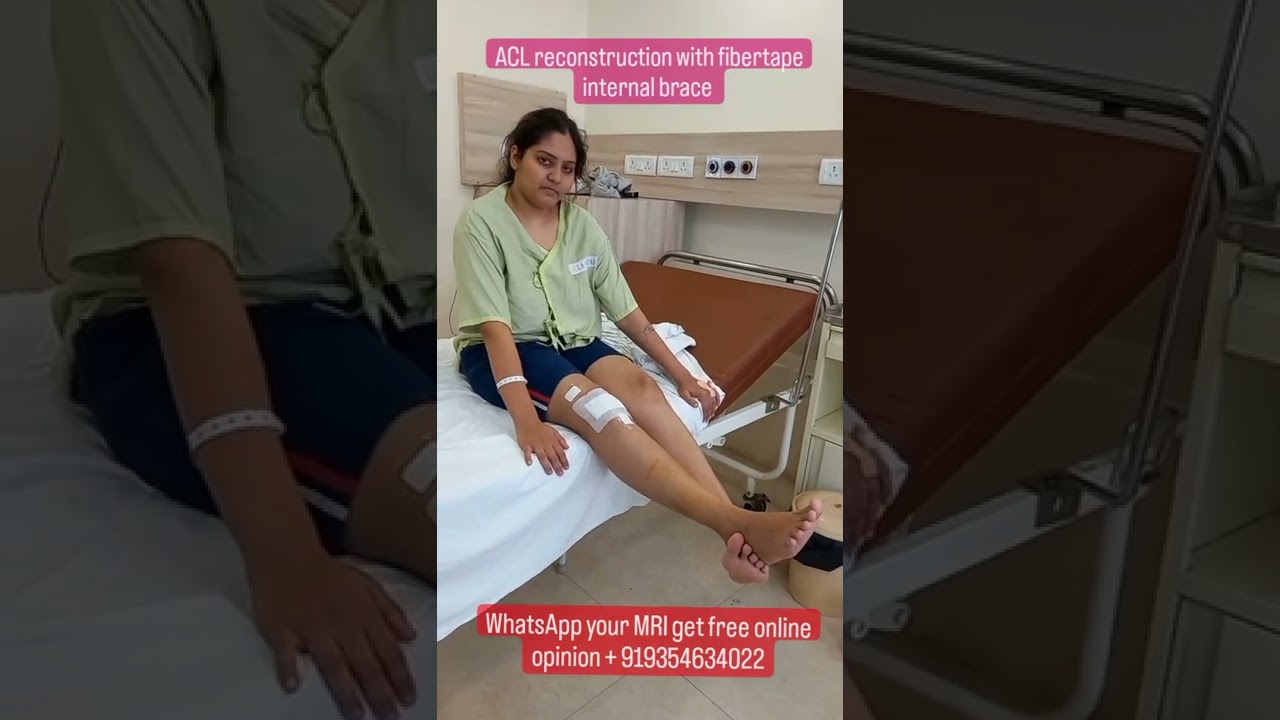 ACL Reconstruction with FiberTape Brace 🦵