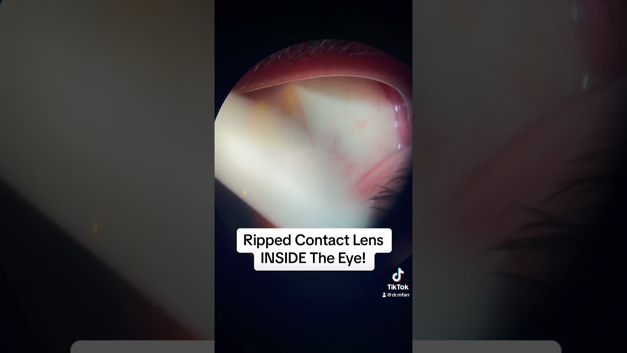 Contact Lens Gets Stuck Inside Eye! ποΈ #shorts