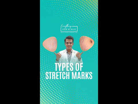 Types of Stretch Marks