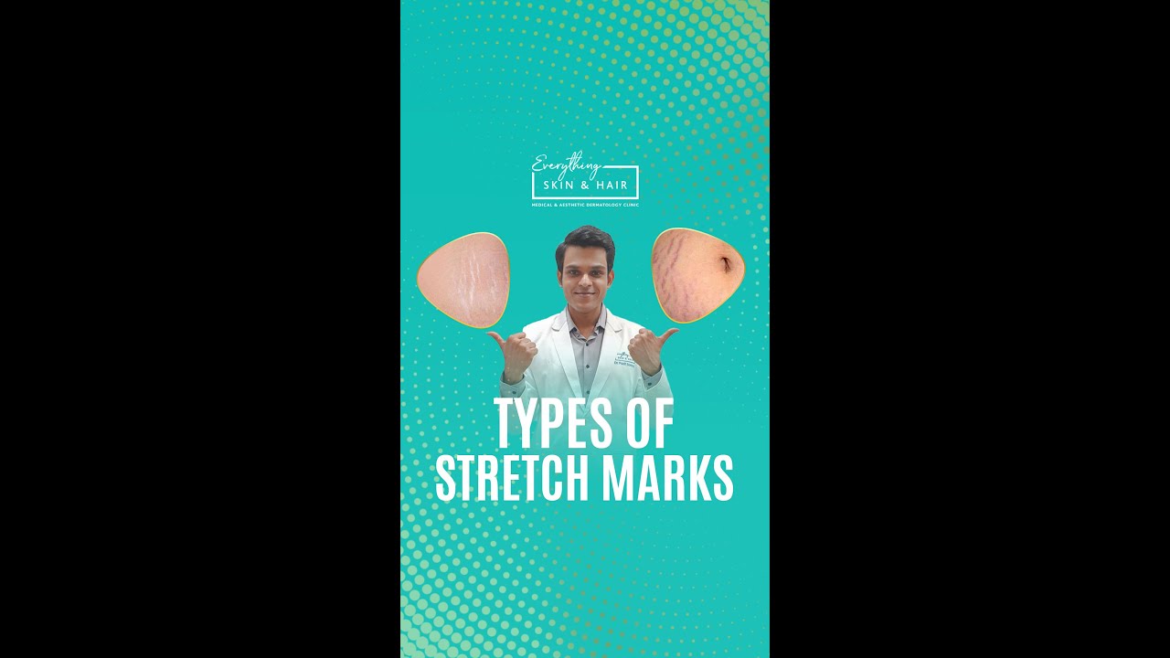 Discover the Two Types of Stretch Marks: Red and White 🌟