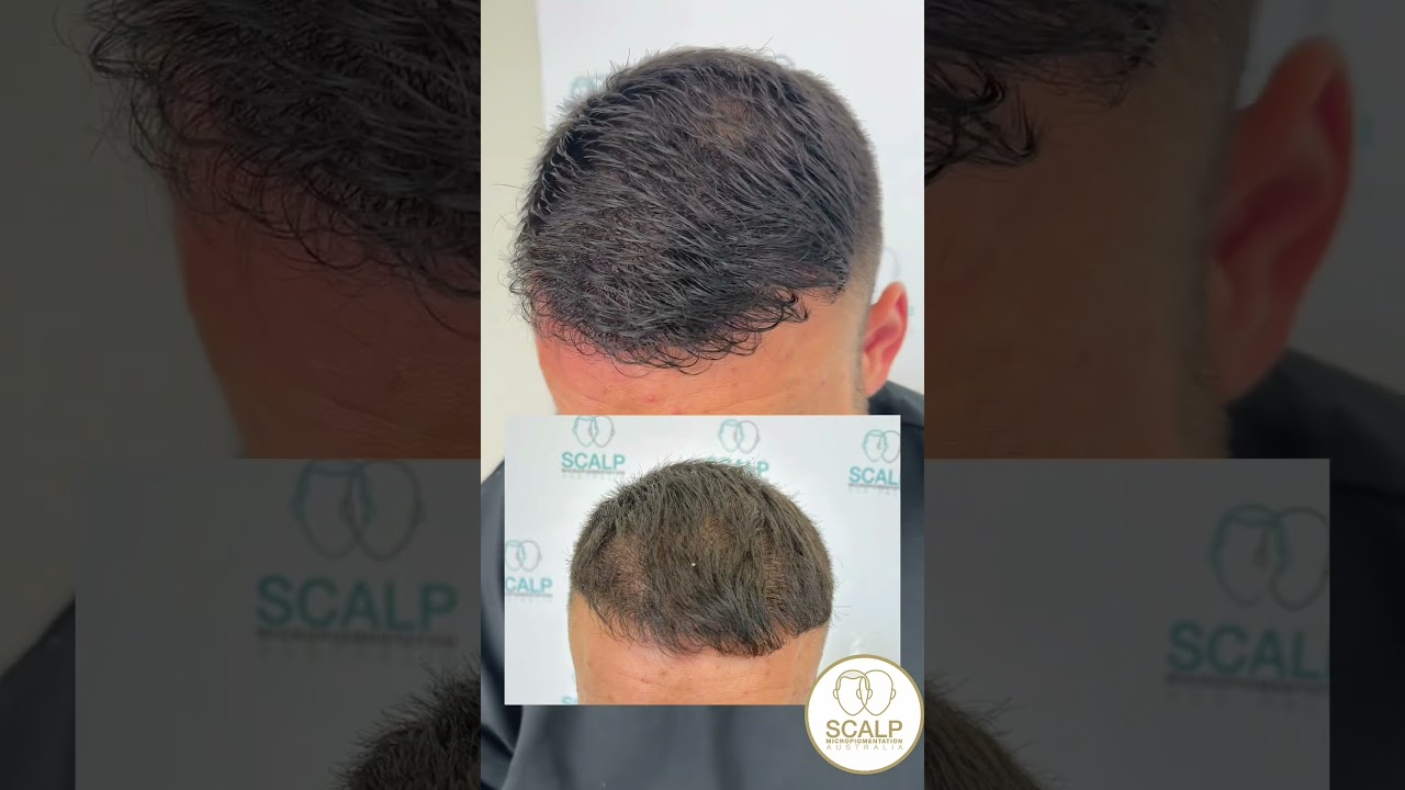 Top Scalp MicroPigmentation for Hair Density 💇‍♂️
