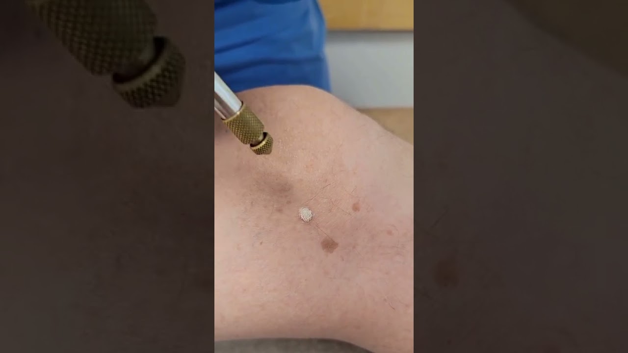 Dermatologist Removes Leg Wart with Liquid Nitrogen ❄️