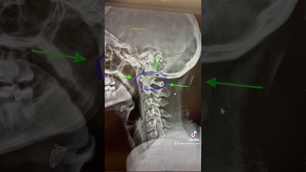 Identifying the Issue: Atlas Misalignment