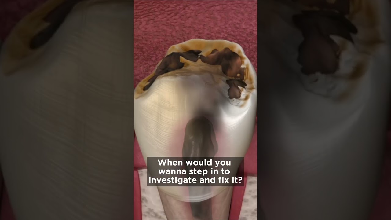 Part 5 - How Long Will My Dental Crown And Filling Last?  Dr. Agatha Bis