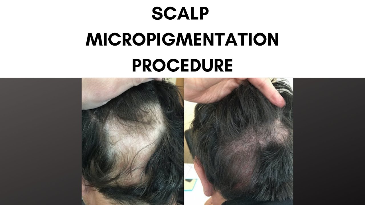 Scalp Micropigmentation at Parsa Mohebi ✨