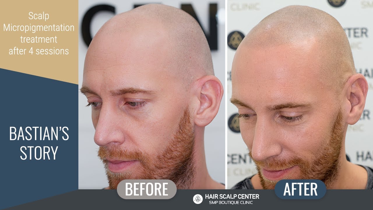 Bastian’s Natural Scalp Micropigmentation at Hair Scalp Center | Bangkok